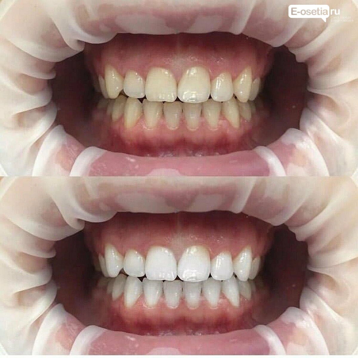 Отбеливание prezident-6_6064588a605cb.jpg